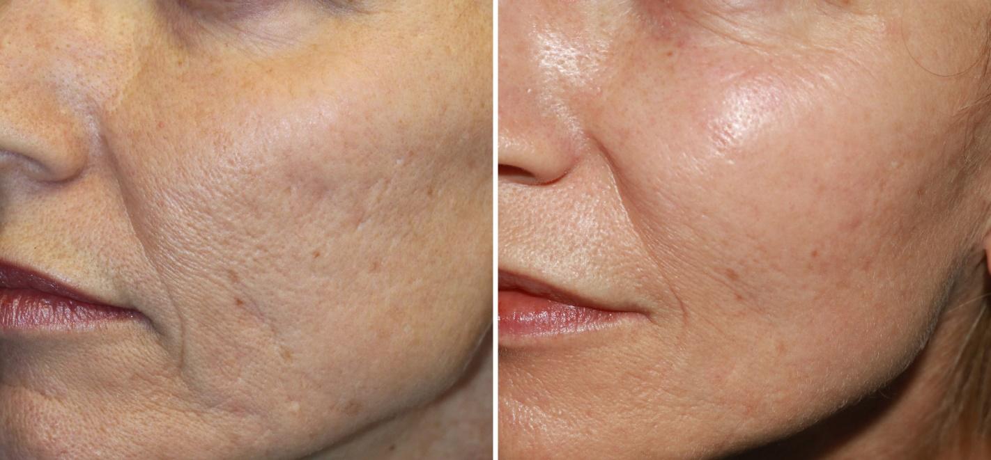 Microneedling for face