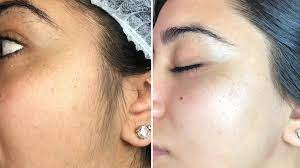 dermaplaning before and after